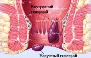 Методы лечения геморроя
